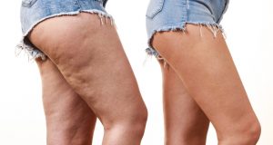 Dr. Jason Emer Reviews How ZWave Treatments Transform and Sculpt Your Physique And Attacks Cellulite