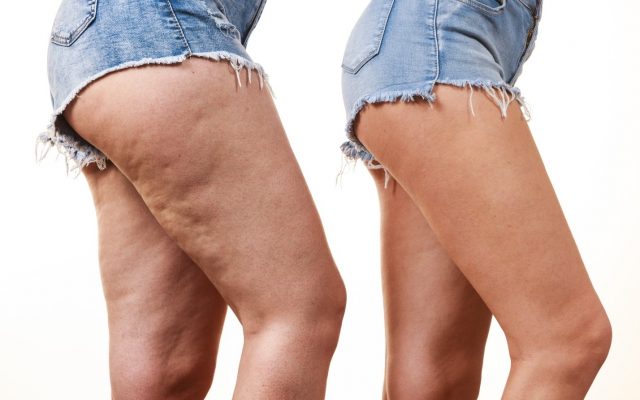 Dr. Jason Emer Reviews How ZWave Treatments Transform and Sculpt Your Physique And Attacks Cellulite